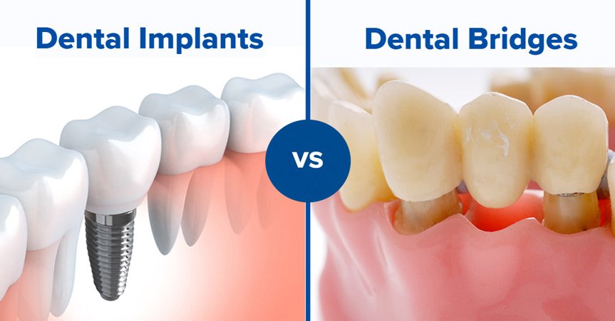 Difference between Bridge and Implant Dental