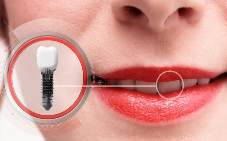 Factors to consider before going for dental implants